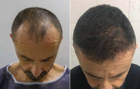 Before After