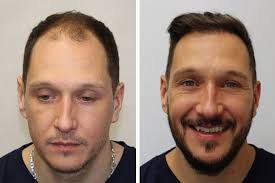 Before After